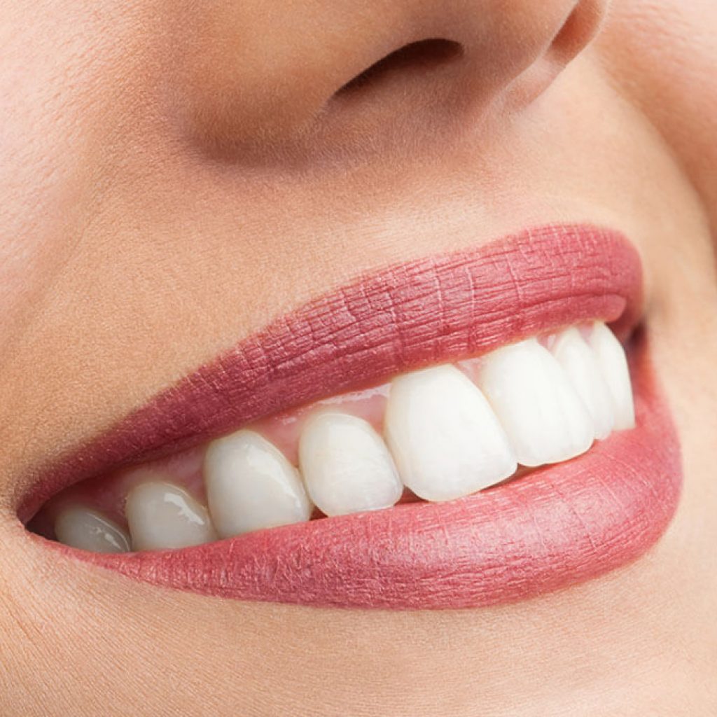 Crown lengthening is usually performed to improve the health of the gum tissue, prepare the mouth for a procedure...