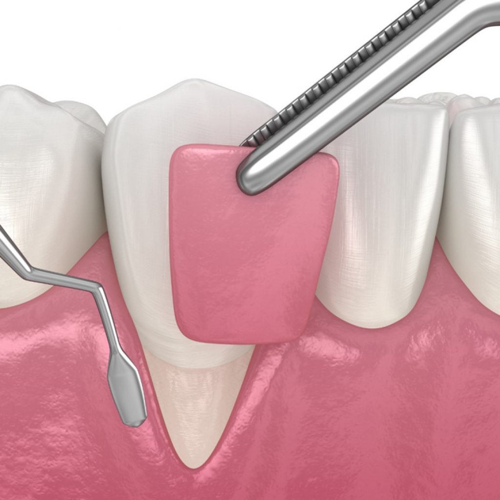 When gum recession occurs, the body loses a natural defense against both bacterial penetration and trauma.