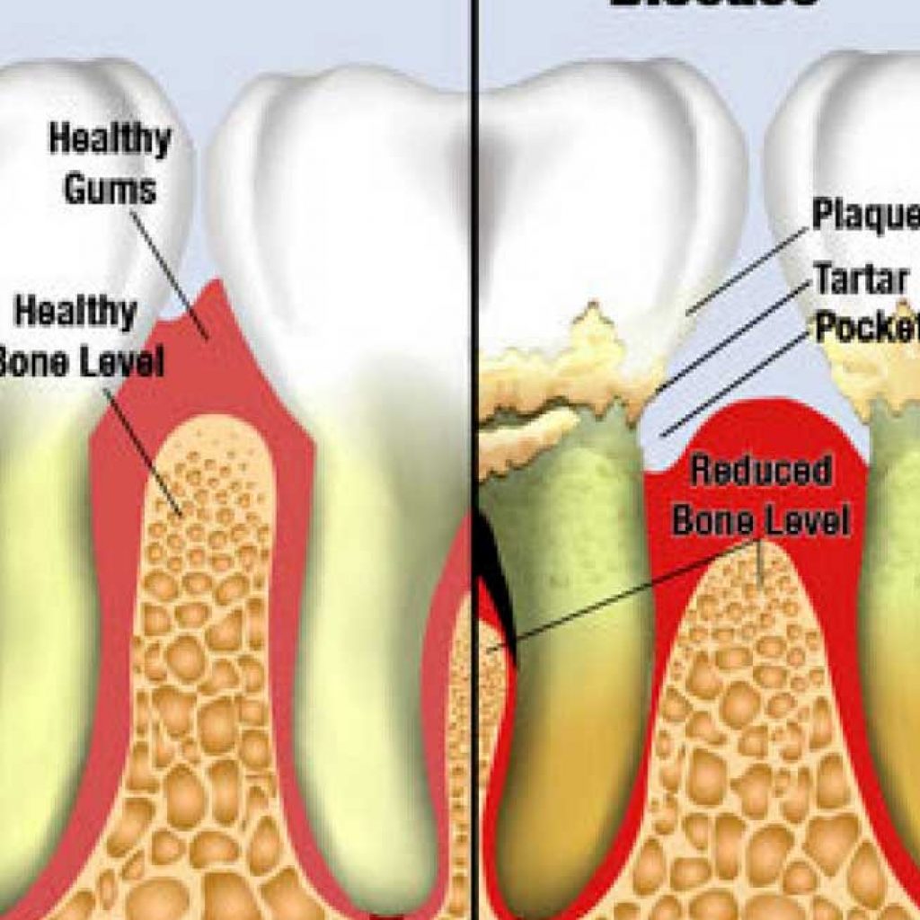 Periodontal treatment is necessary when various conditions affect the health of your gums...