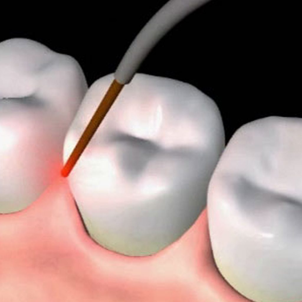 Laser treatment is a minimally-invasive way to treat gum disease without scalpels or stitches.