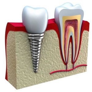 single-tooth-2