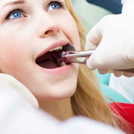 tooth-extraction-and-socket-preservation-2