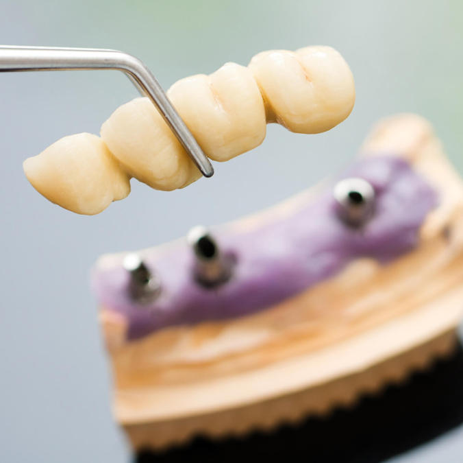 all-on-four-dental-implants
