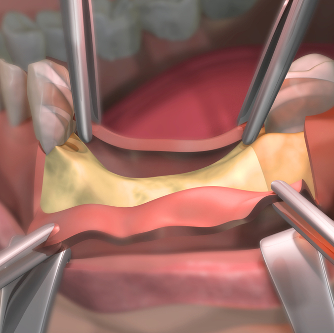 bone-grafting