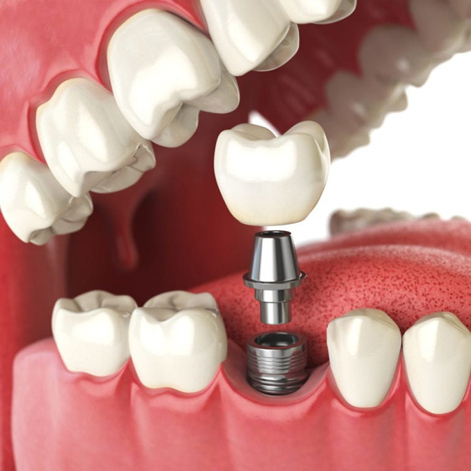 dental-implant