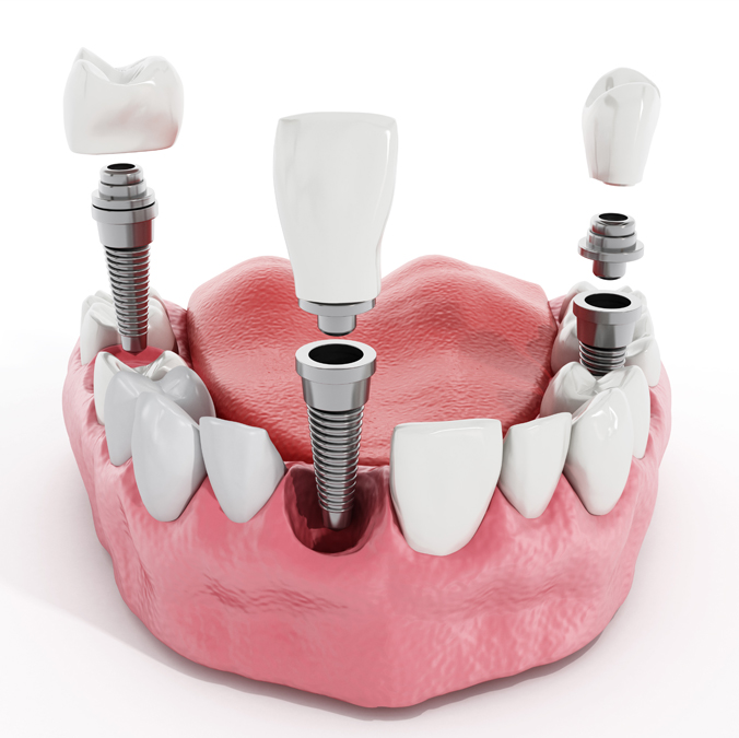 multi-tooth