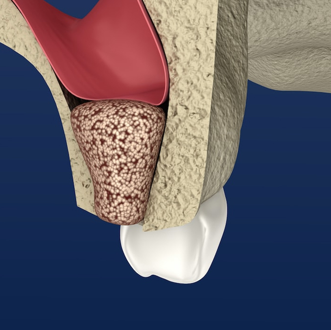 sinus-bone-augmentation